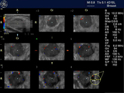 fibroadenoma_color_3d_tui_cplane.jpg
