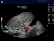 s1-5_end_stage_cirrhotic_liver_pv_thrombus2.jpg