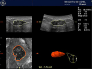 vocal_fibroadenoma1.jpg