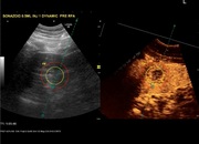 ceus-liver-plus05-start-image.jpg
