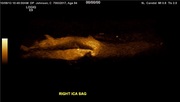 stenosis-start-image.jpg