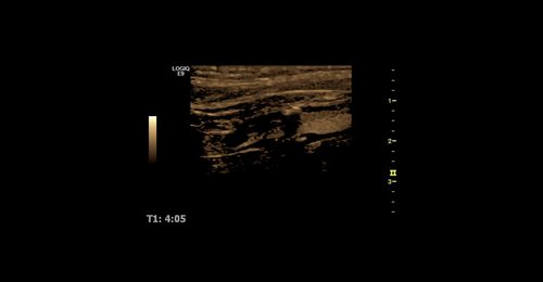 Dr. Weskott - A Clinical Case Study How and Why to Use CEUS for Carotid Plaque 