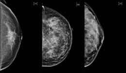 Breast Densitiy