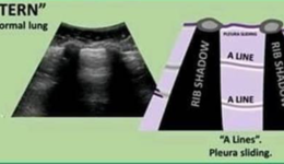 Lung Ultrasound for COVID-19