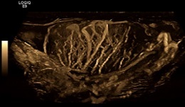 B-Flow Technology