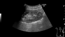 LOGIQ E9 2D US Biopsy of Non-Dilated Kidney 