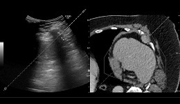 LOGIQ E9 Bx Thorax Tumor