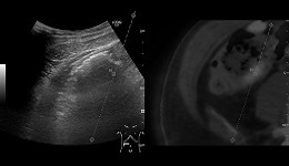 LOGIQ E9 Colon Bx Using PET