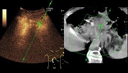LOGIQ E9 Difficult to See Pancreas Bx