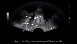  Prof. Puech - MR-guided TRUS prostate biopsies using GE's ...