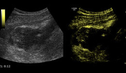 Cases from Experts - Ultrasound-guided Percutaneous Abscess ...