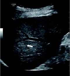 v_nav_fusion_image_in_us_guided_ir_procedures.jpg